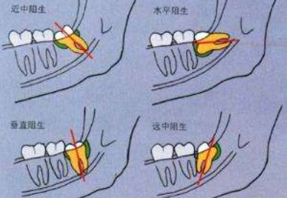 智齿是哪个牙齿：第三磨牙(大部分智齿需拔除)