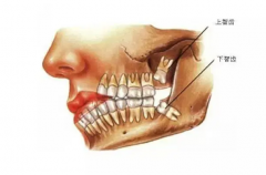 智齿一般长在哪儿：上、下颌牙弓靠里的地方(阻生智齿)