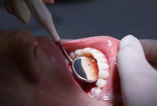 为什么医生不推荐洗牙深层的牙结石怎么洗?三个建议(明白了)